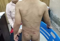 Đã có kết luận thương tích bé trai bị cha dượng đánh dã man ở Phú Quốc